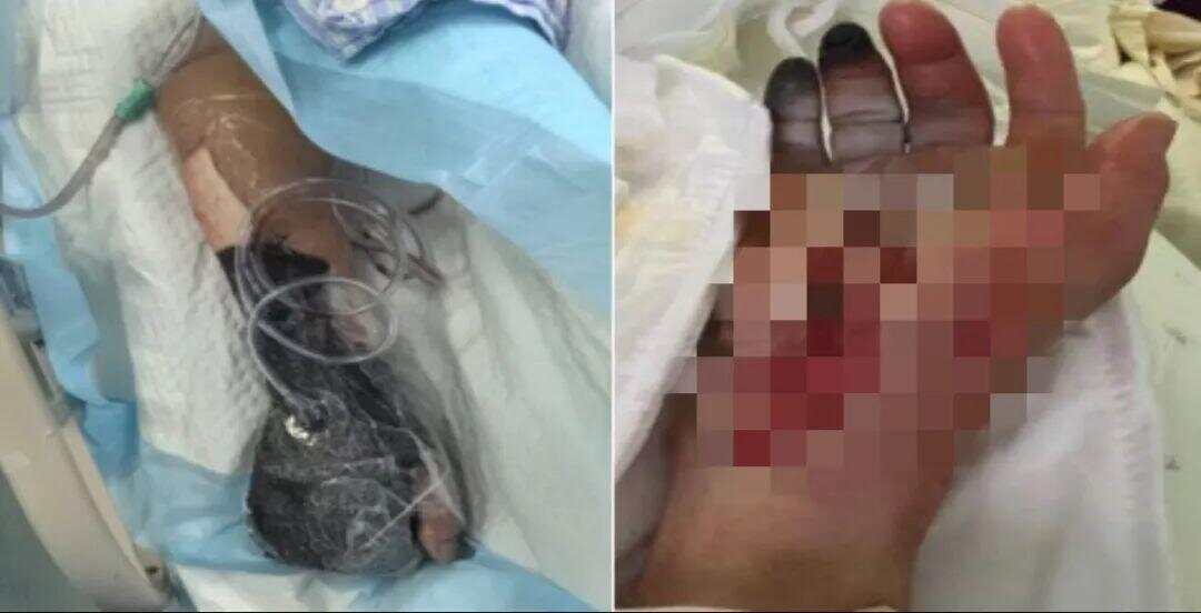 光脚踩到死鱼进ICU