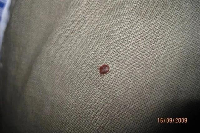 几乎绝迹床虱又出现床虱重现，几乎绝迹的威胁再次浮现